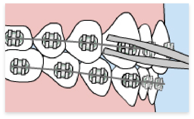 graphic of loose wires in braces in mouth