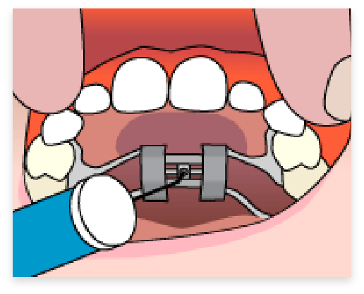 graphic of step 2 of palatel expander process