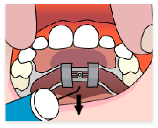 graphic of step 4 of palatel expander process