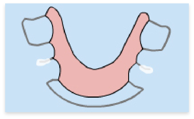 graphic of loose appliances in braces