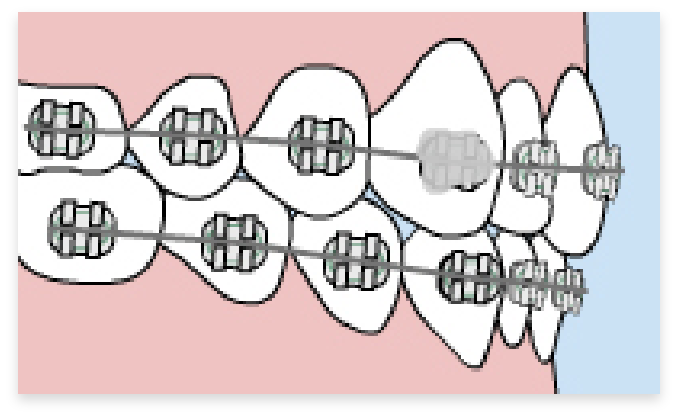 graphic of loose bracket in braces