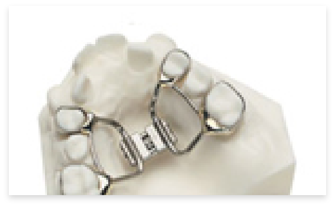 palatal expander on teeth