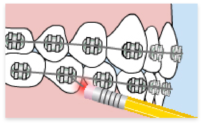graphic of braces poking into gums of mouth